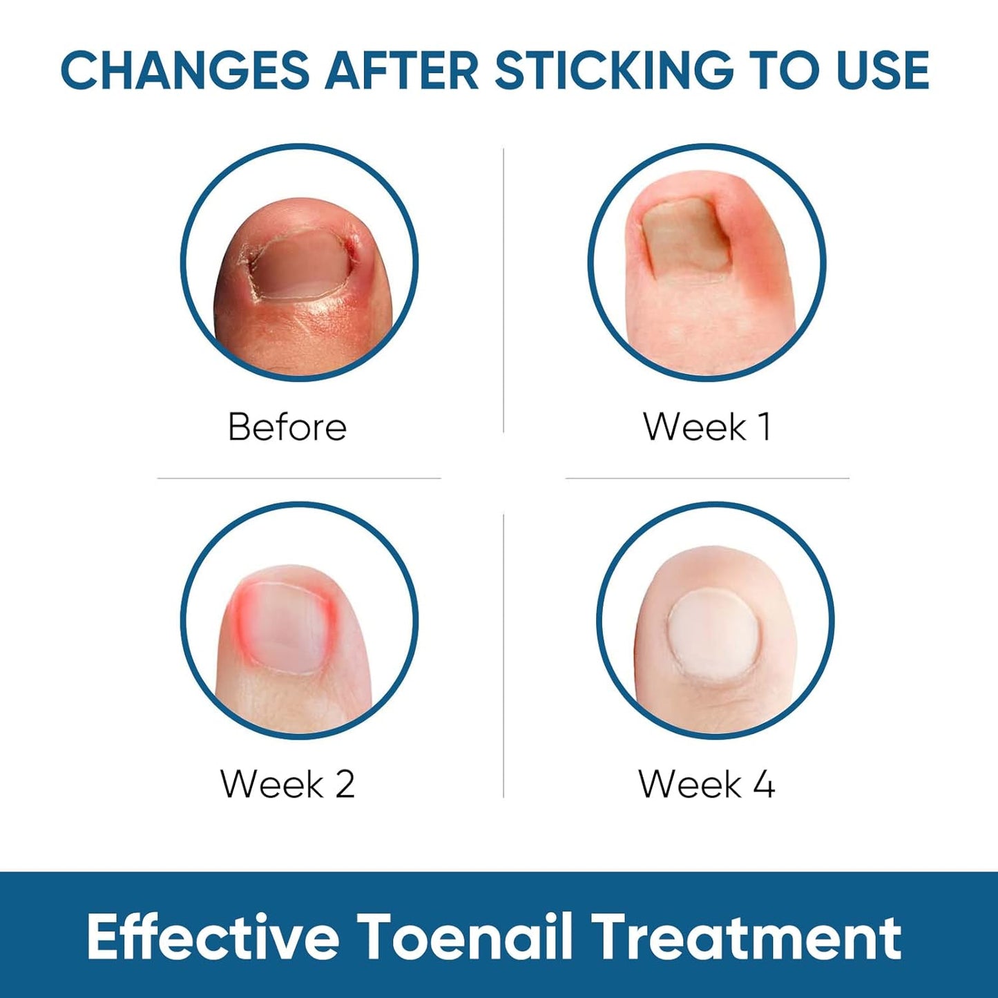 Ingrown Toenail Treatment, 60Pcs Ingrown Toenail Corrector Strips, Ingrown Toenail Removal Kit with File and Lifter, 60Pcs