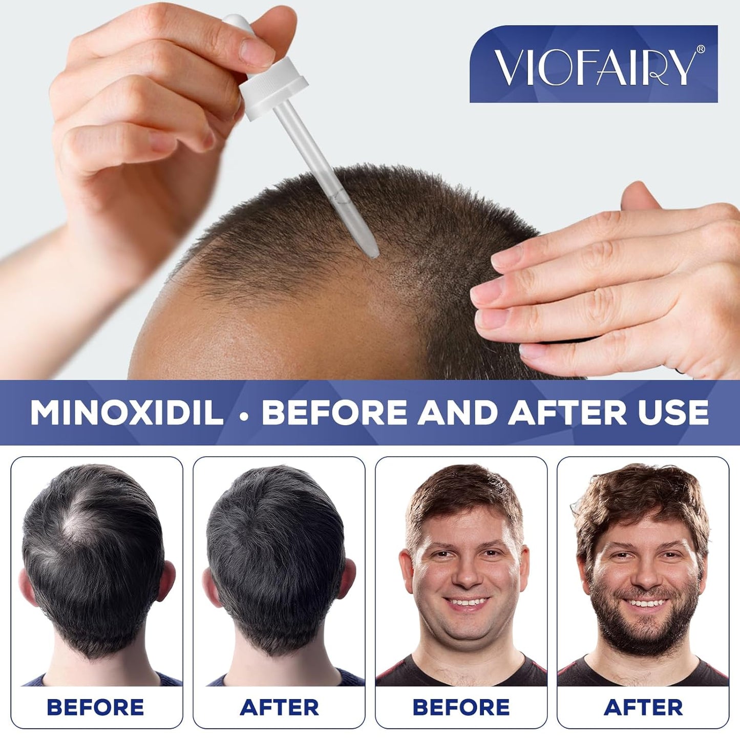 5% Minoxidil for Men and Women, Hair Regrowth Treatment for Thinning Hair and Hair Loss, Topical Solution - 1 Months Supply - Dermatologist recommended (Pack of 1)