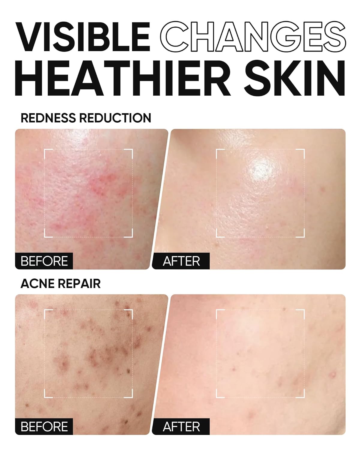 5X Ceramides Moisture Barrier Cream, Hydrating Skin Barrier Repair Face Moisturizer for All Skin Types with Hyaluronic Acid & Centella, Daily Moisturizer, Non-Comedogenic