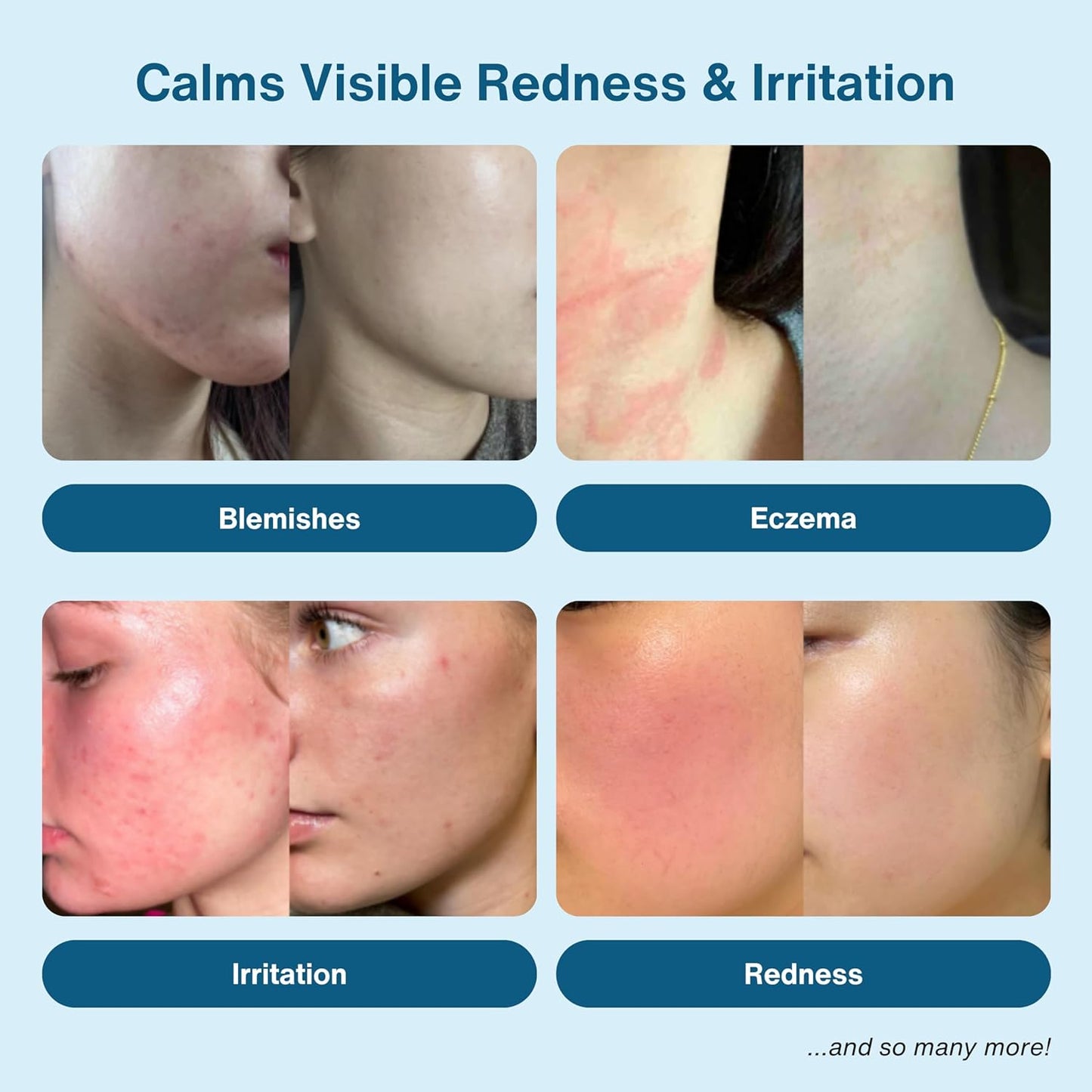 Hypochlorous Acid Spray – HOCl Face & Skin Mist for Acne, Eczema & Irritation – Multi-Purpose Skin Repair – Eyelid Cleanser, Post-Workout, Post-Procedure, Scalp & Sensitive Skin – 6.8 oz