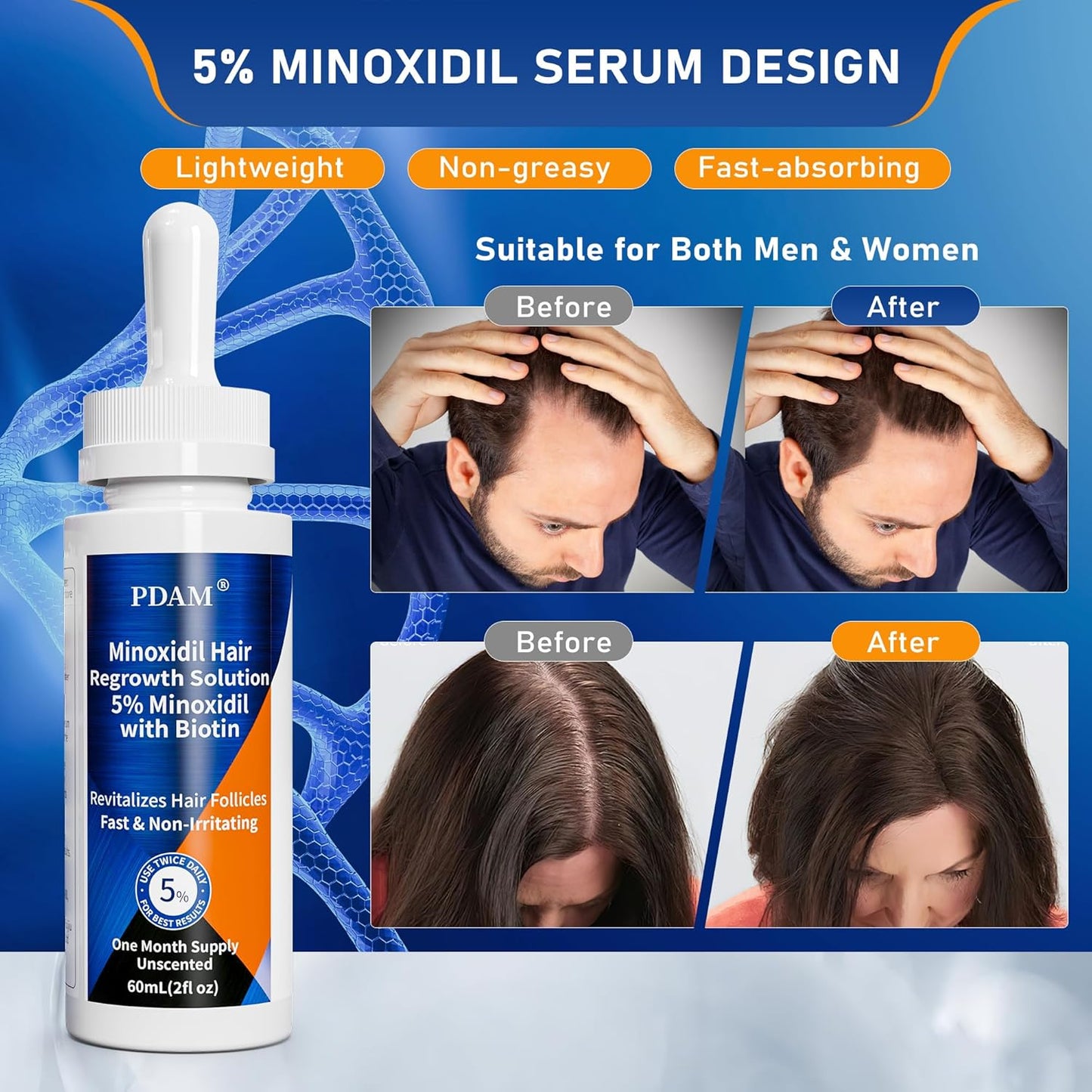 5% Minoxidil for Men Hair & Beard Growth Kit, Minoxidil for Women Hair Growth Serum, Extra Strength Hair Loss Treatment for Thinning Hair, Promotes Thicker Fuller Regrowth, Nourishes Scalp, 2 × 2oz
